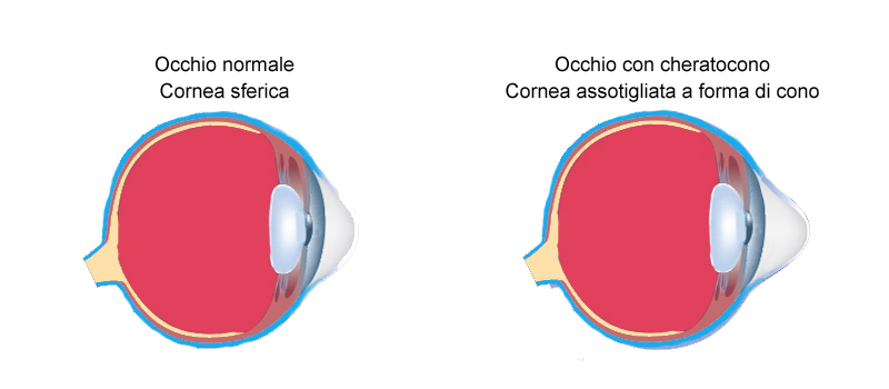 occhio sano e con cheratono