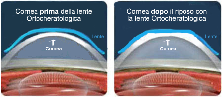 Le lenti agiscono mentre si dorme